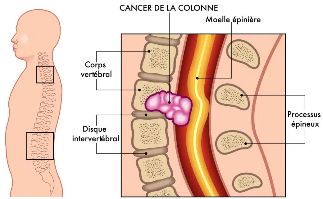 Détecter un Cancer lié au Mal de Dos : Comprendre les Symptômes, les Causes et les Voies de Prise en Charge